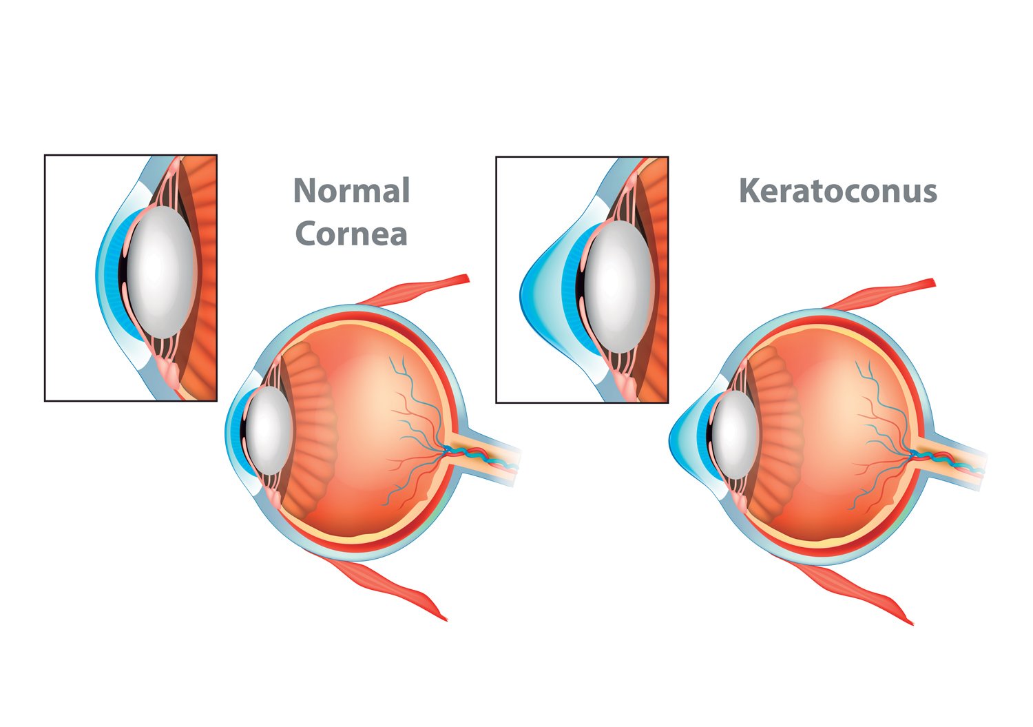 Três maneiras de tratar o terçol - Alpha Diagnose Oftalmologia