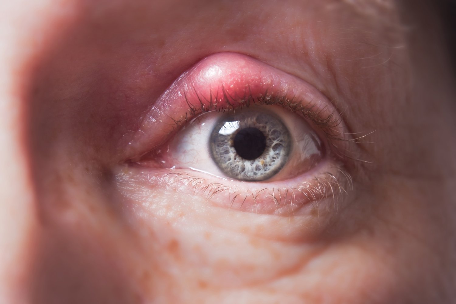 Clínica de olhos Levate - 👀 Terçol ou Hordéolo: 1. O que é? Pequeno nódulo  infeccioso na região palpebral, mais precisamente na base dos cílios.  Geralmente ocorre por uma obstrução das glândulas